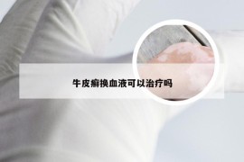 牛皮癣换血液可以治疗吗