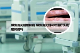 煤焦油洗剂银屑病 煤焦油洗剂可以治疗头皮银屑病吗