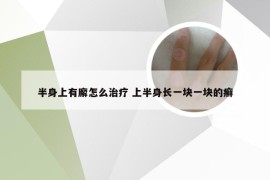 半身上有廨怎么治疗 上半身长一块一块的癣