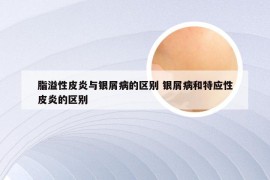 脂溢性皮炎与银屑病的区别 银屑病和特应性皮炎的区别