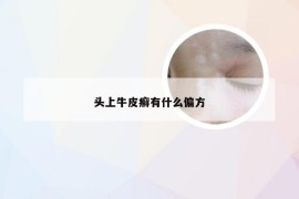 头上牛皮癣有什么偏方