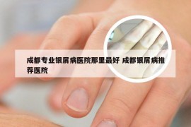 成都专业银屑病医院那里最好 成都银屑病推荐医院