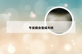 牛皮癣会变成大块