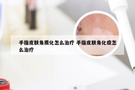 手指皮肤角质化怎么治疗 手指皮肤角化症怎么治疗