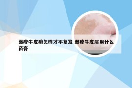 湿疹牛皮癣怎样才不复发 湿疹牛皮屑用什么药膏