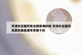 天津长征医院有治银屑病的吗 天津长征医院皮肤科银屑病专家哪个好