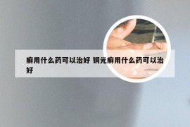 癣用什么药可以治好 铜元癣用什么药可以治好