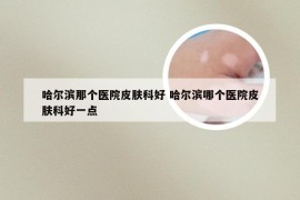哈尔滨那个医院皮肤科好 哈尔滨哪个医院皮肤科好一点