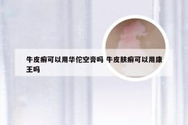 牛皮癣可以用华佗空膏吗 牛皮肤癣可以用康王吗