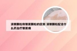 消银颗粒和银屑颗粒的区别 消银颗粒配合什么药治疗银屑病
