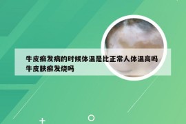 牛皮癣发病的时候体温是比正常人体温高吗 牛皮肤癣发烧吗