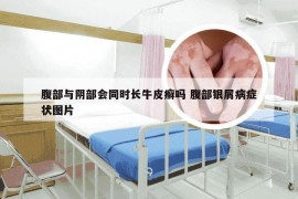 腹部与阴部会同时长牛皮癣吗 腹部银屑病症状图片