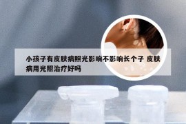 小孩子有皮肤病照光影响不影响长个子 皮肤病用光照治疗好吗