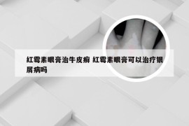 红霉素眼膏治牛皮癣 红霉素眼膏可以治疗银屑病吗