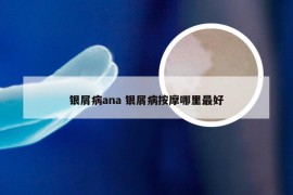 银屑病ana 银屑病按摩哪里最好