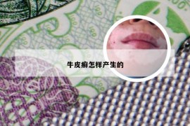牛皮癣怎样产生的