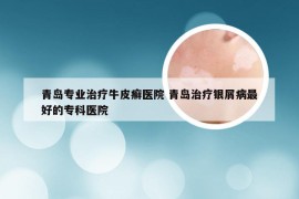 青岛专业治疗牛皮癣医院 青岛治疗银屑病最好的专科医院