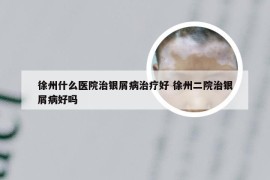 徐州什么医院治银屑病治疗好 徐州二院治银屑病好吗