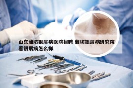 山东潍坊银屑病医院招聘 潍坊银屑病研究院看银屑病怎么样