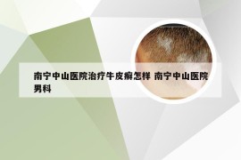 南宁中山医院治疗牛皮癣怎样 南宁中山医院男科