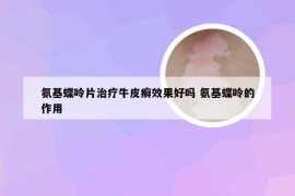氨基蝶呤片治疗牛皮癣效果好吗 氨基蝶呤的作用