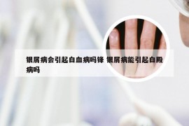 银屑病会引起白血病吗锋 银屑病能引起白殿病吗
