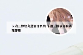 卡泊三醇软膏是治什么的 卡泊三醇软膏的药理作用