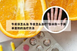 牛皮该怎么治 牛皮怎么治疗?告诉你一个简单显效的治疗方法