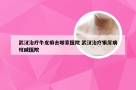 武汉治疗牛皮癣去哪家医院 武汉治疗银屑病权威医院