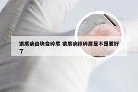 银屑病由块变碎屑 银屑病掉碎屑是不是要好了