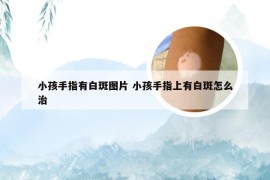 小孩手指有白斑图片 小孩手指上有白斑怎么治