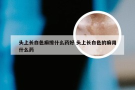 头上长白色癣擦什么药好 头上长白色的癣用什么药