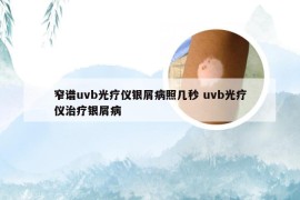 窄谱uvb光疗仪银屑病照几秒 uvb光疗仪治疗银屑病