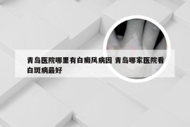 青岛医院哪里有白癜风病因 青岛哪家医院看白斑病最好