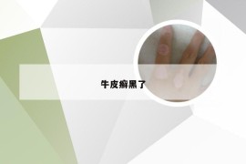 牛皮癣黑了