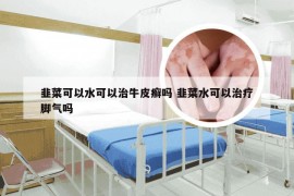 韭菜可以水可以治牛皮癣吗 韭菜水可以治疗脚气吗