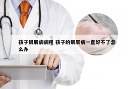 孩子银屑病病程 孩子的银屑病一直好不了怎么办