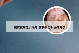 成皮肤癣怎么治疗 皮肤癣怎么治疗方法