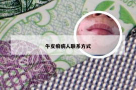 牛皮癣病人联系方式