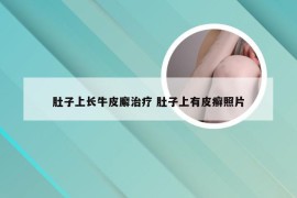 肚子上长牛皮廨治疗 肚子上有皮癣照片