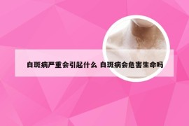 白斑病严重会引起什么 白斑病会危害生命吗