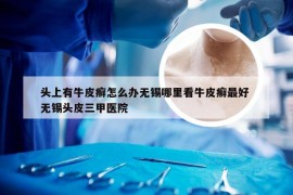 头上有牛皮癣怎么办无锡哪里看牛皮癣最好 无锡头皮三甲医院