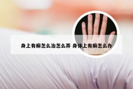 身上有癣怎么治怎么弄 身体上有癣怎么办