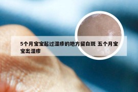 5个月宝宝起过湿疹的地方留白斑 五个月宝宝出湿疹
