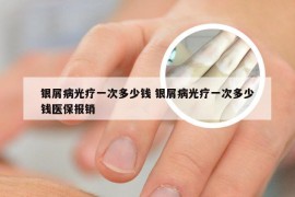 银屑病光疗一次多少钱 银屑病光疗一次多少钱医保报销