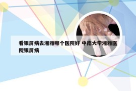 看银屑病去湘雅哪个医院好 中南大学湘雅医院银屑病