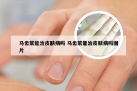 马齿菜能治皮肤病吗 马齿菜能治皮肤病吗图片
