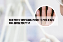 郑州哪家看银屑病最好的医院 郑州哪里有看银屑病的医院比较好