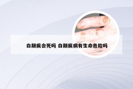 白颠疯会死吗 白颠疯病有生命危险吗