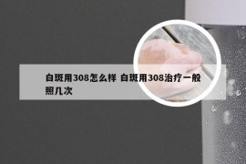 白斑用308怎么样 白斑用308治疗一般照几次